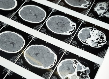 Why is Accurate MRI Report Translation So Important?