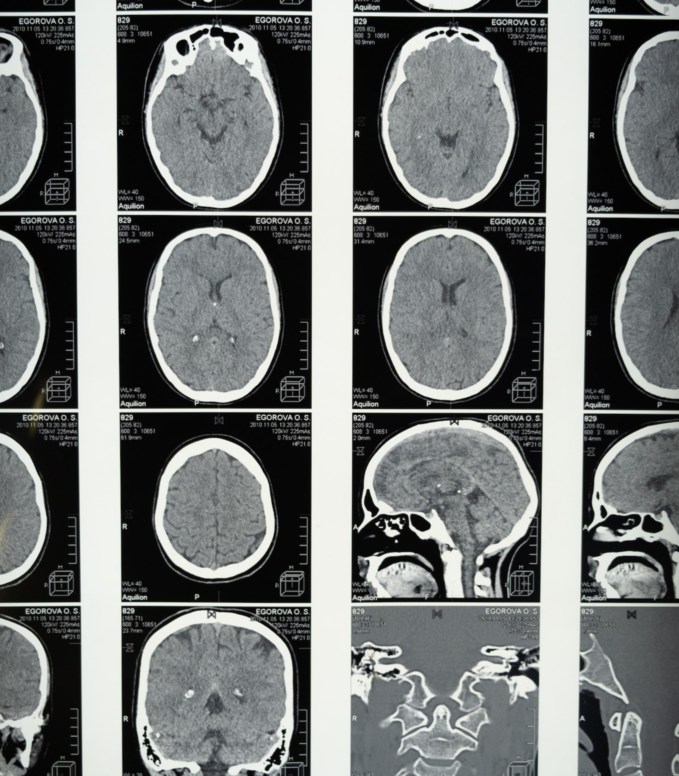 Why is Accurate MRI Report Translation So Important?