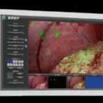 Endoscopic Fluorescent Imaging System