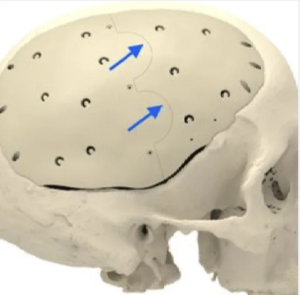 Van menselijke botten tot Marsrovers: Hoe vormt de PEEK-plaat- en staafextrusielijn van Jwell MachineryTP5T039; de piekwaarde van de "Koning van kunststoffen"?
